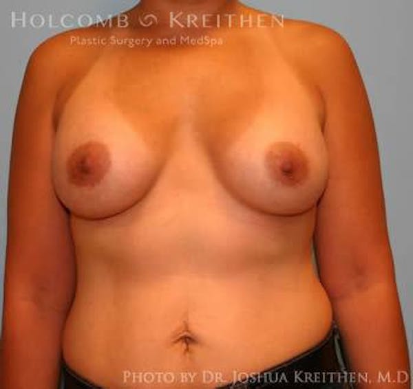 Breast Augmentation Before & After Gallery - Patient 6236608 - Image 2