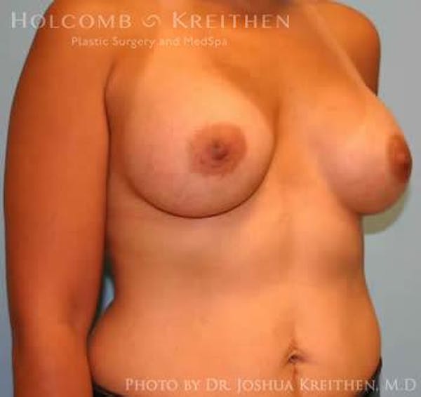 Breast Augmentation Before & After Gallery - Patient 6236608 - Image 4