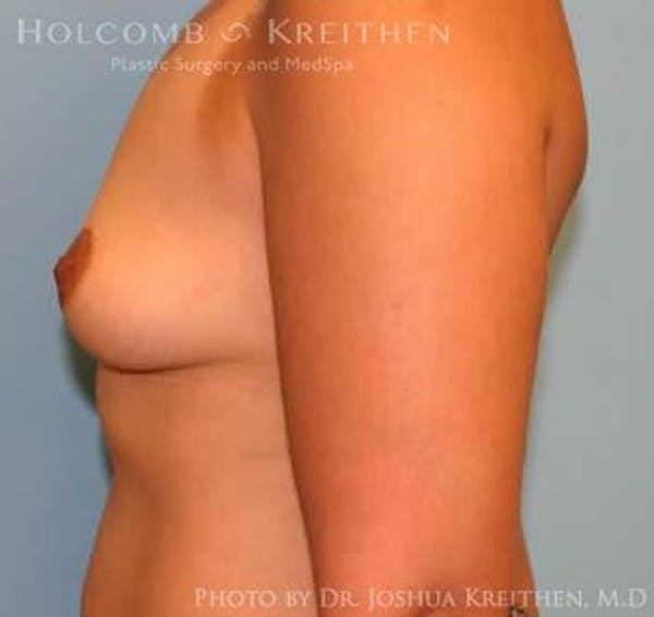 Breast Augmentation Before & After Gallery - Patient 6236608 - Image 5