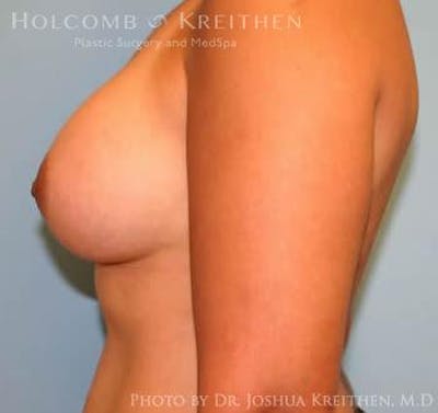 Breast Augmentation Before & After Gallery - Patient 6236608 - Image 6