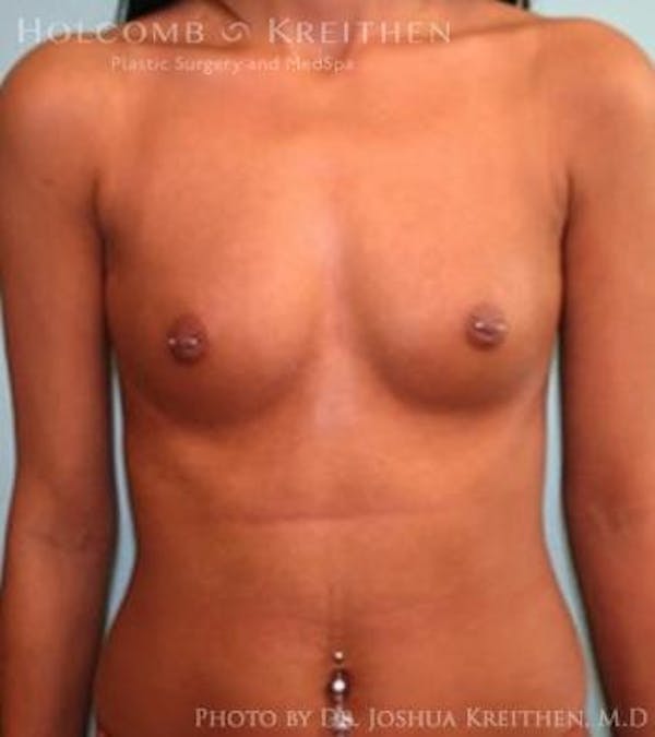 Breast Augmentation Gallery - Patient 6236610 - Image 1