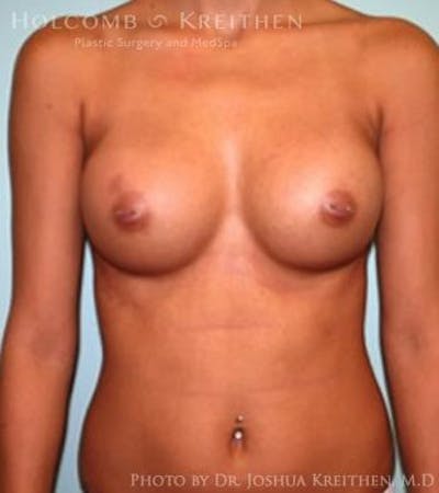 Breast Augmentation Before & After Gallery - Patient 6236610 - Image 2