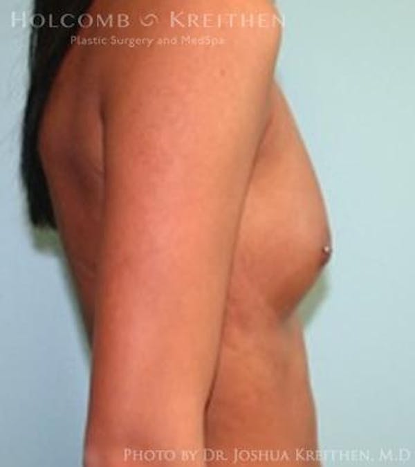 Breast Augmentation Before & After Gallery - Patient 6236610 - Image 5