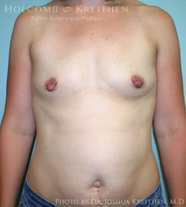Breast Augmentation Before & After Gallery - Patient 6236612 - Image 1