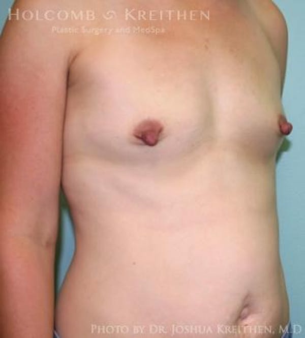 Breast Augmentation Gallery - Patient 6236612 - Image 3