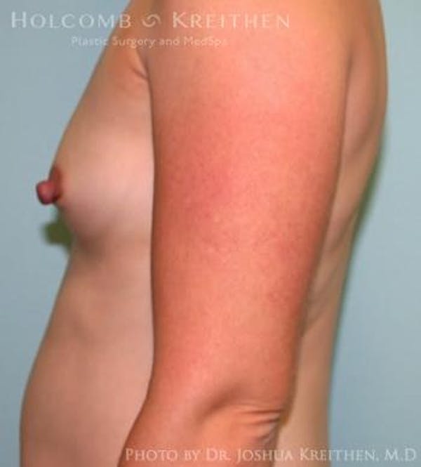 Breast Augmentation Before & After Gallery - Patient 6236612 - Image 5