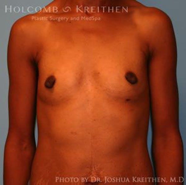 Breast Augmentation Before & After Gallery - Patient 6236613 - Image 1