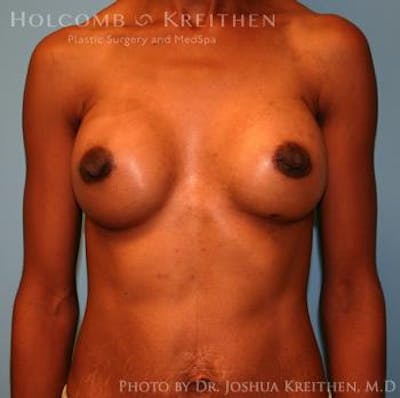 Breast Augmentation Before & After Gallery - Patient 6236613 - Image 2