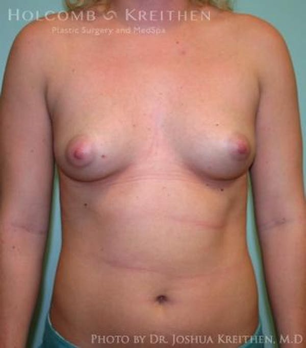 Breast Augmentation Gallery - Patient 6236614 - Image 1