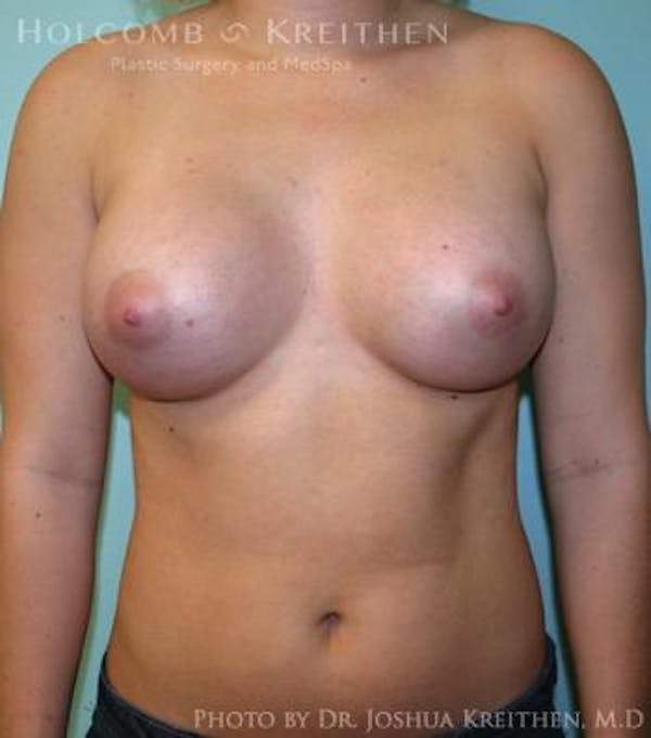Breast Augmentation Gallery - Patient 6236614 - Image 2