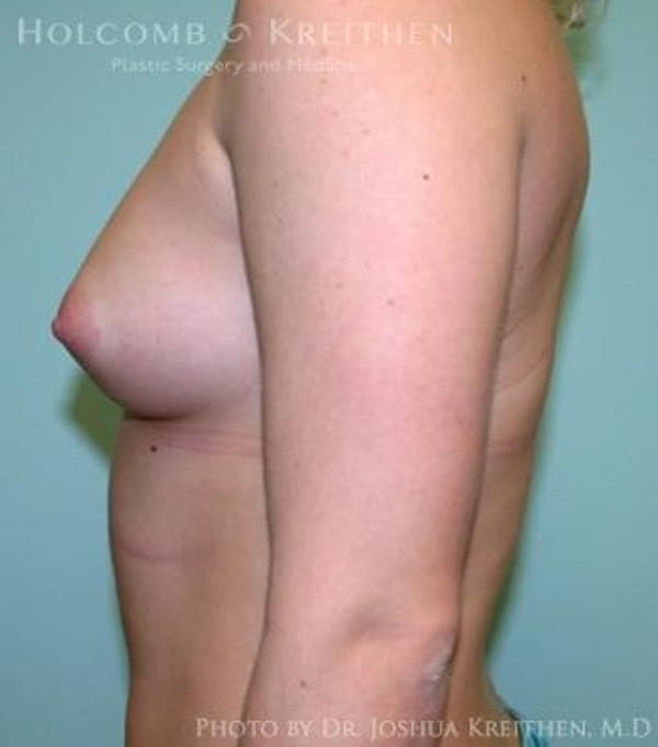 Breast Augmentation Before & After Gallery - Patient 6236614 - Image 5
