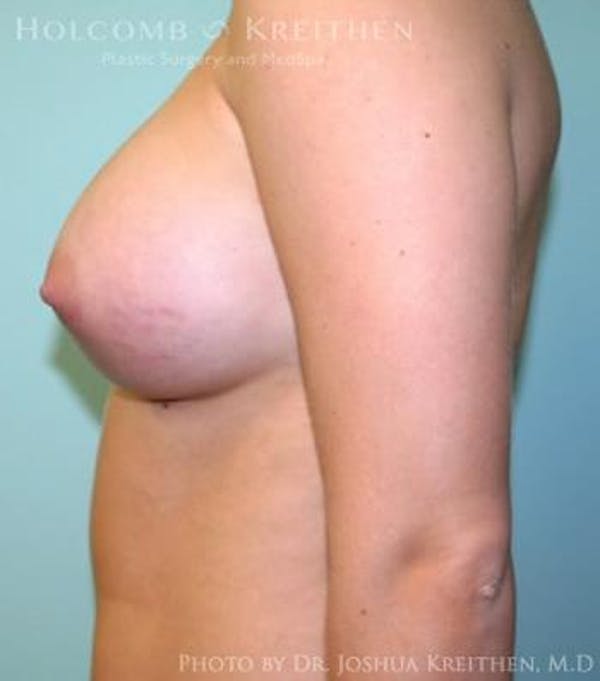 Breast Augmentation Before & After Gallery - Patient 6236614 - Image 6