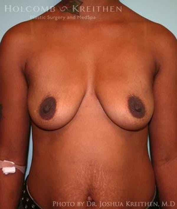 Breast Augmentation Before & After Gallery - Patient 6236616 - Image 1
