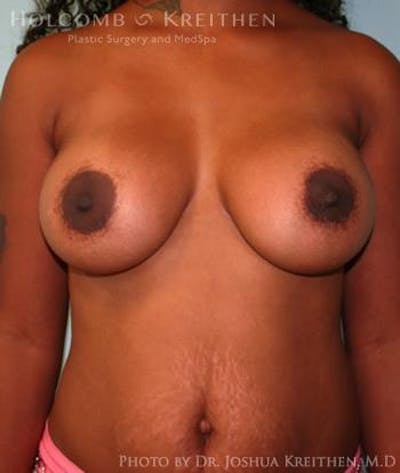 Breast Augmentation Before & After Gallery - Patient 6236616 - Image 2