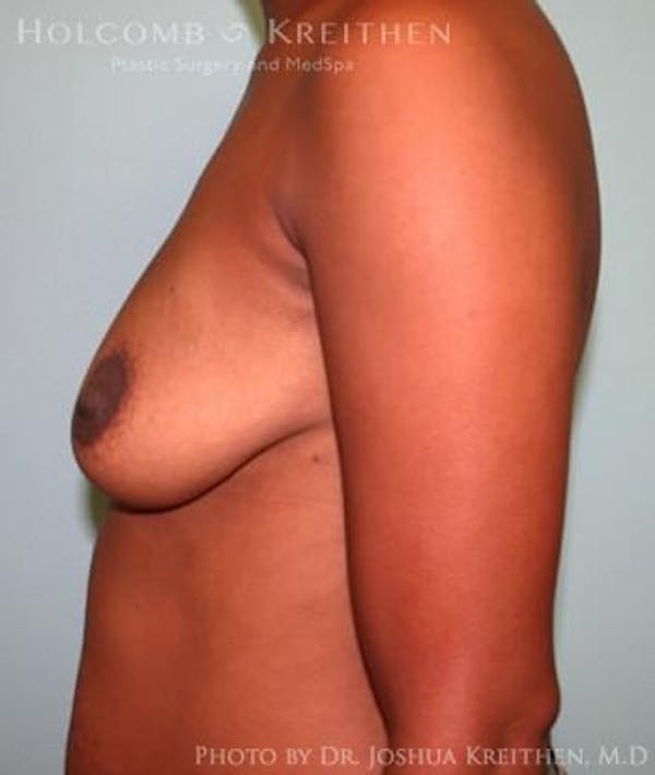 Breast Augmentation Gallery - Patient 6236616 - Image 5