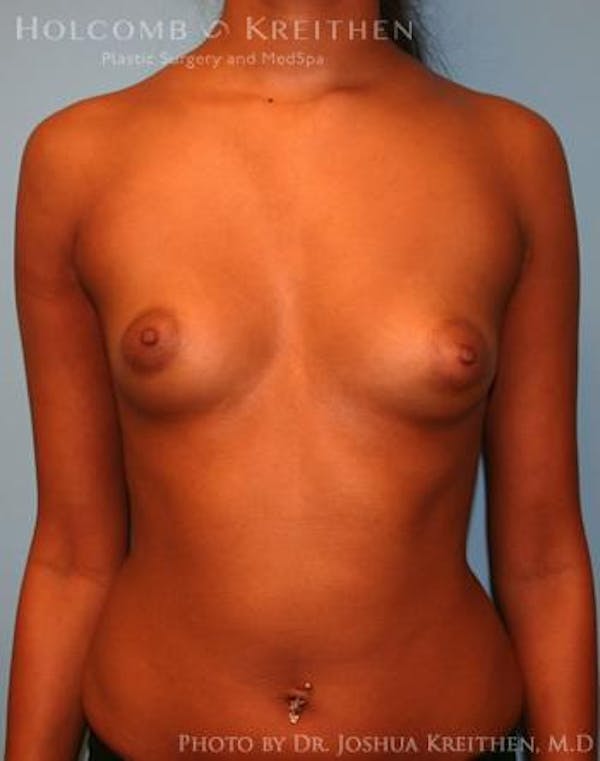 Breast Augmentation Before & After Gallery - Patient 6236618 - Image 1