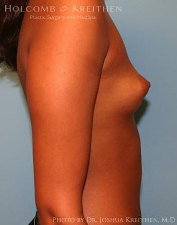 Breast Augmentation Before & After Gallery - Patient 6236618 - Image 5