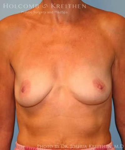 Breast Augmentation Before & After Gallery - Patient 6236620 - Image 1