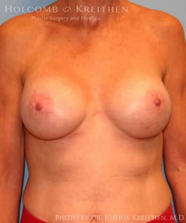 Breast Augmentation Before & After Gallery - Patient 6236620 - Image 2