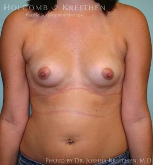 Breast Augmentation Before & After Gallery - Patient 6236623 - Image 1