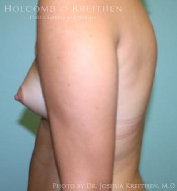 Breast Augmentation Before & After Gallery - Patient 6236623 - Image 5