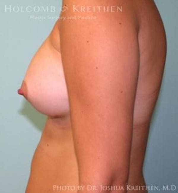 Breast Augmentation Before & After Gallery - Patient 6236623 - Image 6