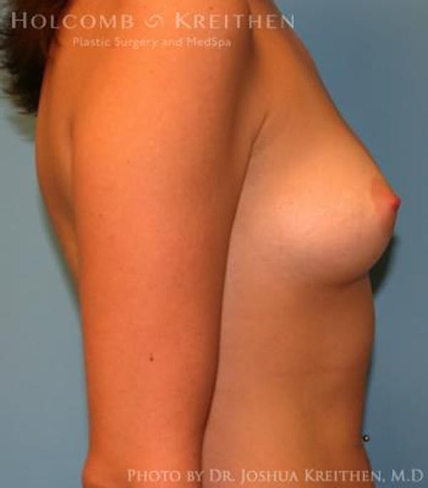 Breast Augmentation Before & After Gallery - Patient 6236627 - Image 5