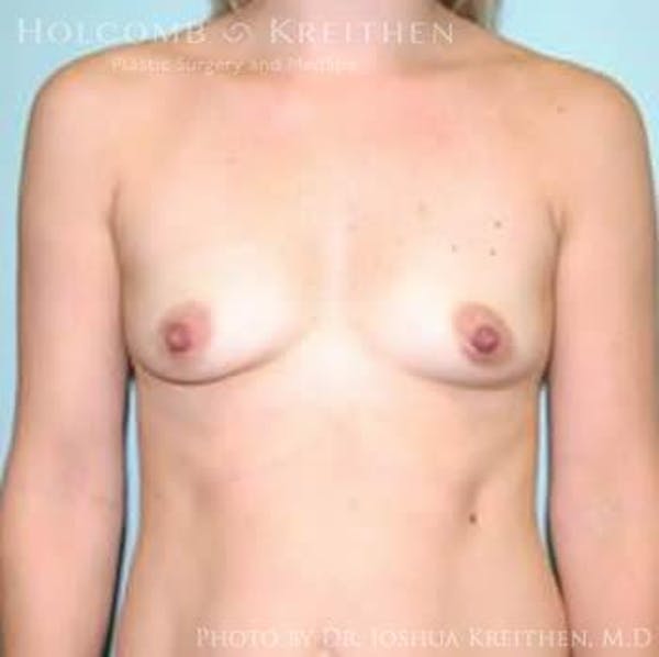 Breast Augmentation Before & After Gallery - Patient 6236629 - Image 1