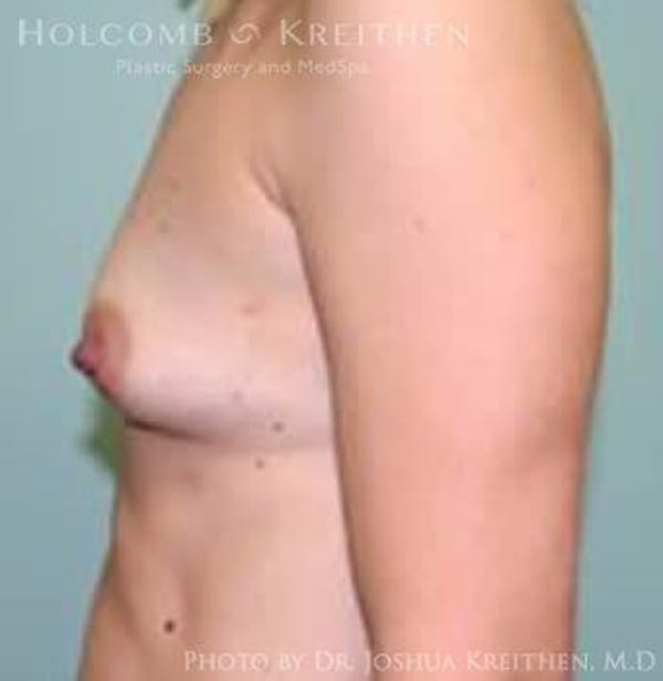 Breast Augmentation Before & After Gallery - Patient 6236629 - Image 5