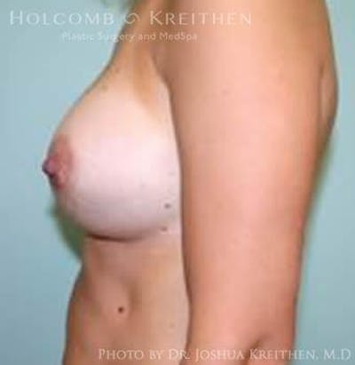 Breast Augmentation Before & After Gallery - Patient 6236629 - Image 6