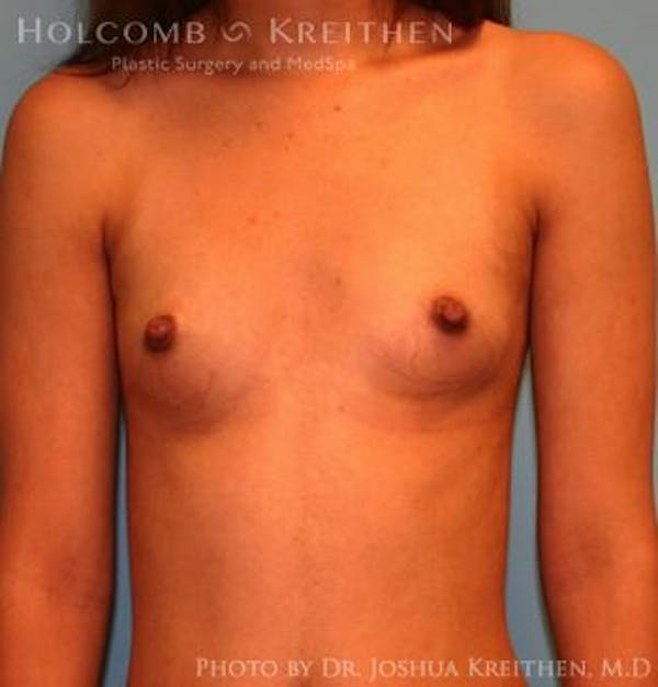 Breast Augmentation Before & After Gallery - Patient 6236636 - Image 1