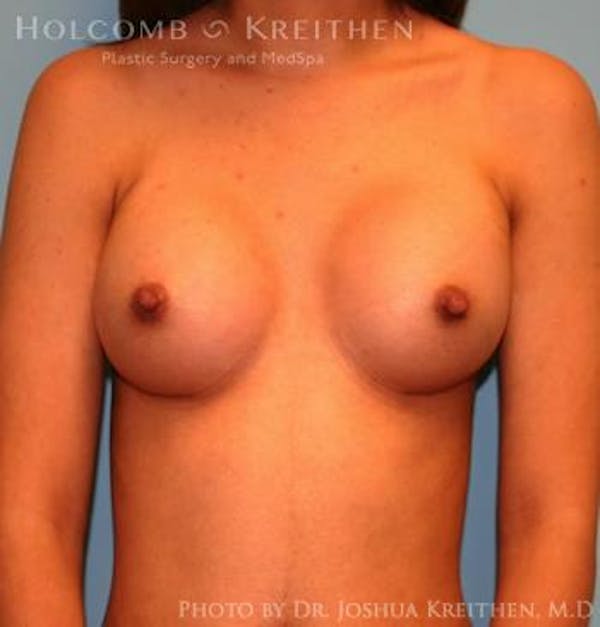 Breast Augmentation Gallery - Patient 6236636 - Image 2