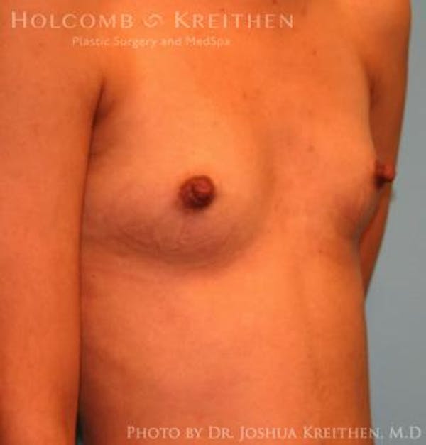 Breast Augmentation Before & After Gallery - Patient 6236636 - Image 3