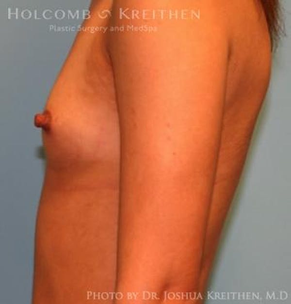 Breast Augmentation Before & After Gallery - Patient 6236636 - Image 5
