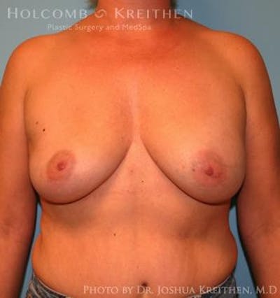 Breast Augmentation Gallery - Patient 6236644 - Image 1
