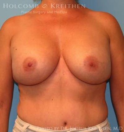 Breast Augmentation Before & After Gallery - Patient 6236644 - Image 2