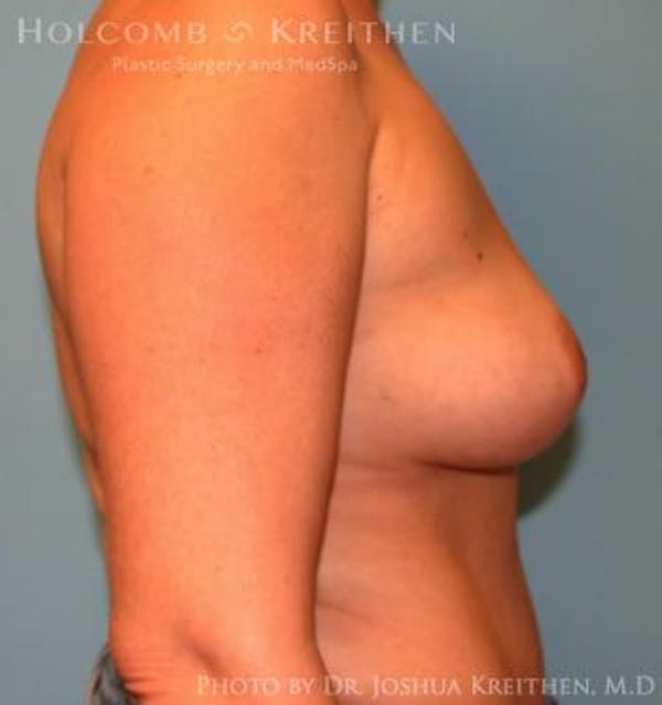 Breast Augmentation Before & After Gallery - Patient 6236644 - Image 5