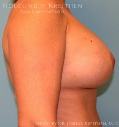 Breast Augmentation Before & After Gallery - Patient 6236644 - Image 6