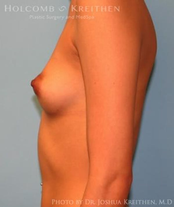 Breast Augmentation Before & After Gallery - Patient 6236646 - Image 5