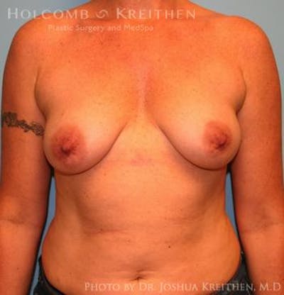 Breast Augmentation Before & After Gallery - Patient 6236651 - Image 1