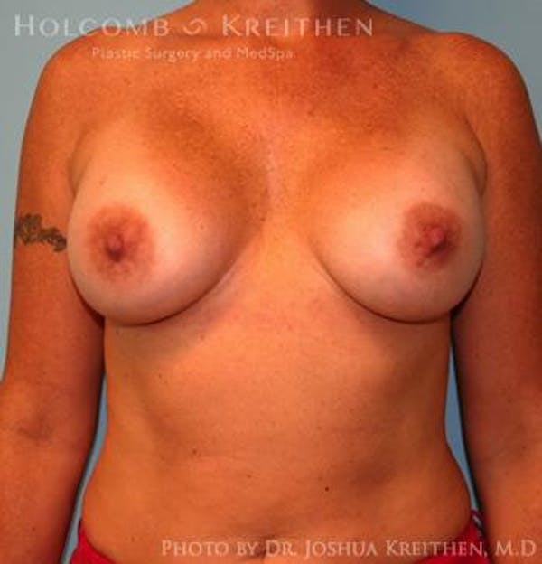 Breast Augmentation Gallery - Patient 6236651 - Image 2
