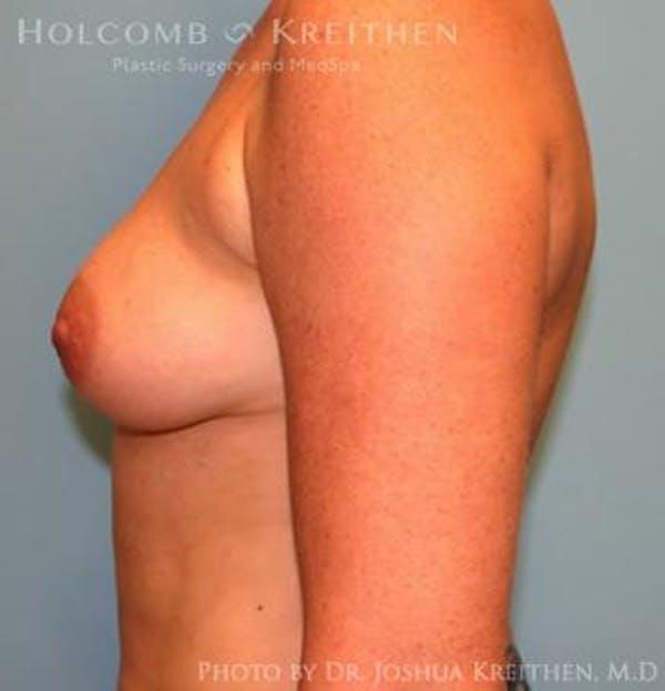 Breast Augmentation Before & After Gallery - Patient 6236651 - Image 5