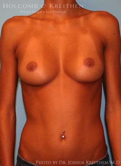 Breast Augmentation Before & After Gallery - Patient 6236655 - Image 1