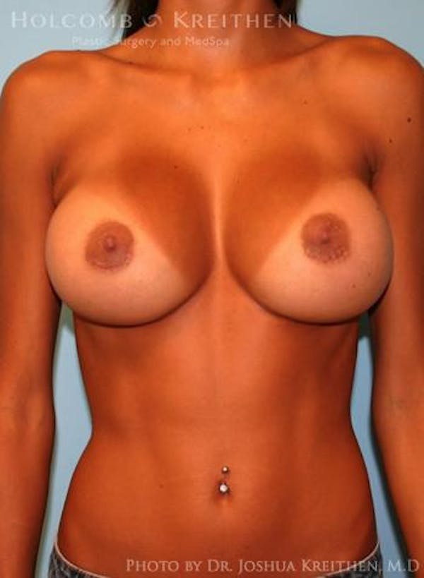 Breast Augmentation Before & After Gallery - Patient 6236655 - Image 2