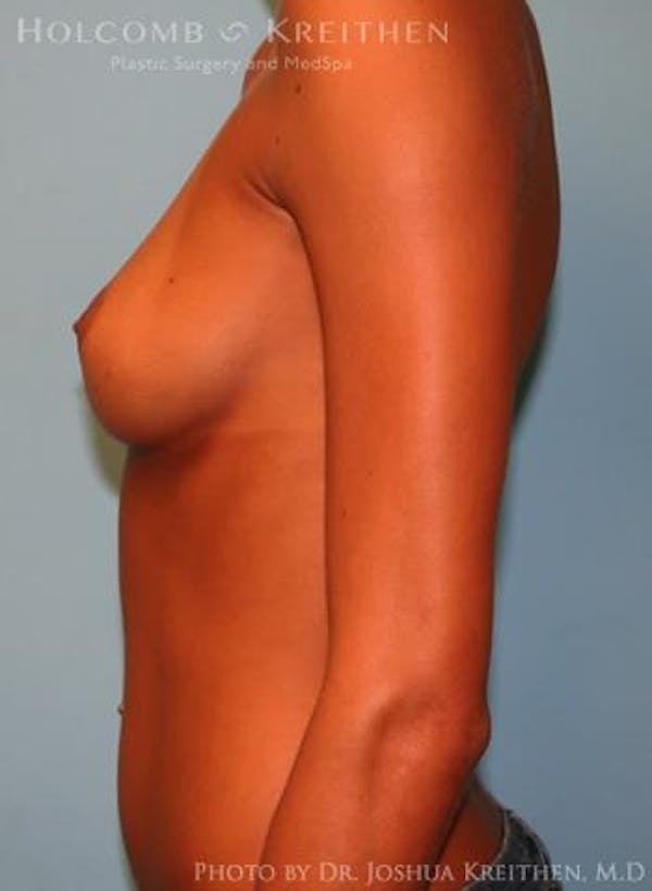 Breast Augmentation Before & After Gallery - Patient 6236655 - Image 5