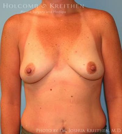 Breast Augmentation Before & After Gallery - Patient 6236657 - Image 1