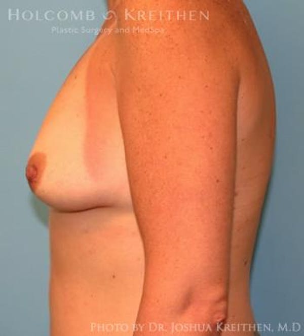 Breast Augmentation Gallery - Patient 6236657 - Image 5