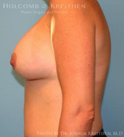 Breast Augmentation Before & After Gallery - Patient 6236657 - Image 6