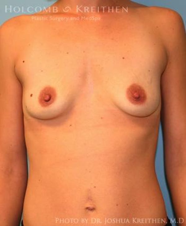 Breast Augmentation Before & After Gallery - Patient 6236663 - Image 1