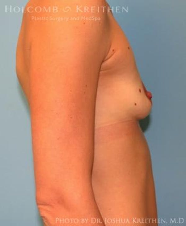 Breast Augmentation Before & After Gallery - Patient 6236663 - Image 5